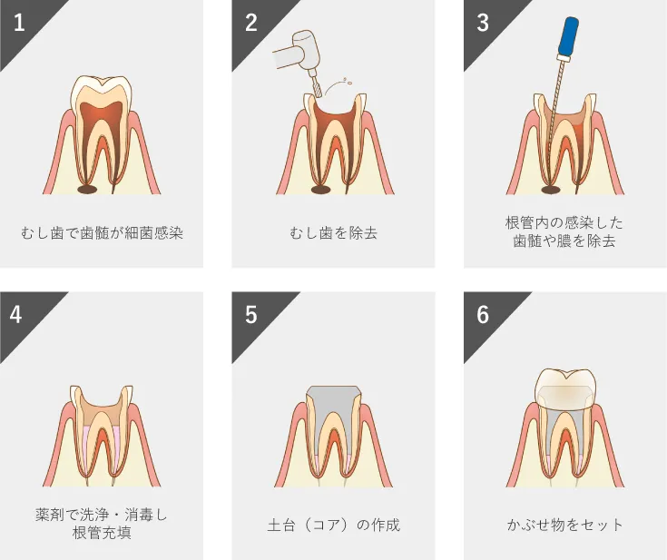 根管治療の流れ