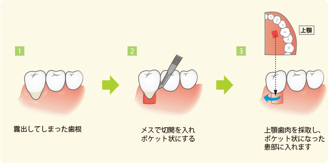 歯茎移植術