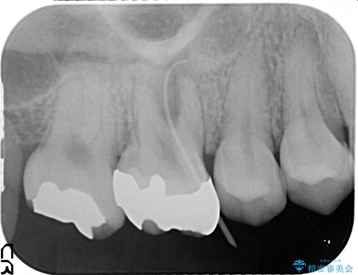 歯茎がはれた　根の治療をしっかり行ってからのセラミック治療 治療前画像