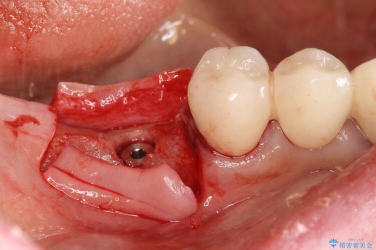 歯がない部分にインプラントとセラミックブリッジによる治療 治療途中画像
