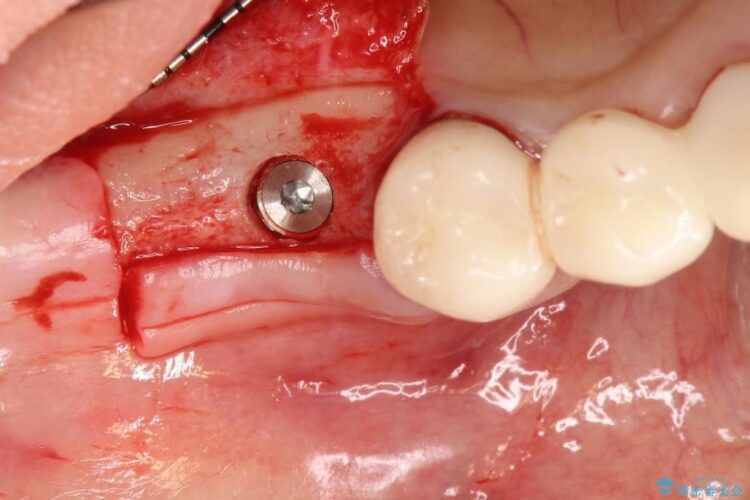 歯がない部分にインプラントとセラミックブリッジによる治療 治療途中画像
