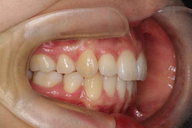 八重歯の矯正　ハーフリンガルによる目立たない抜歯矯正 治療後画像