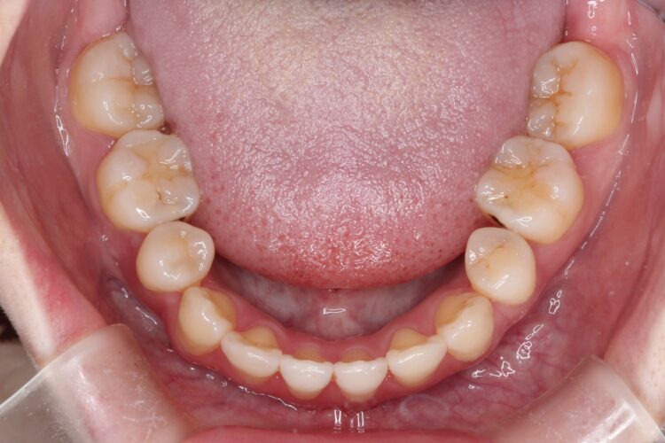 前歯で咬めない　ワイヤーでの抜歯矯正 治療後画像