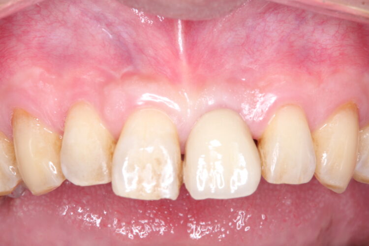 プロフェッショナルクリーニング（PMTC)で歯のステインを除去 治療前画像