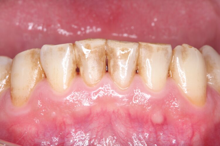 プロフェッショナルクリーニング（PMTC)で歯のステインを除去 治療前画像