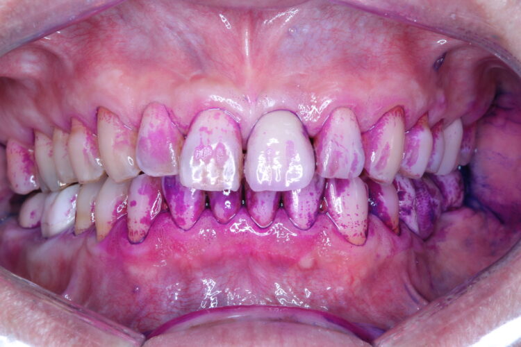 プロフェッショナルクリーニング（PMTC)で歯のステインを除去 治療途中画像