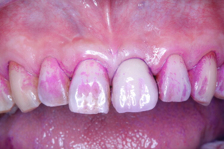プロフェッショナルクリーニング（PMTC)で歯のステインを除去 治療途中画像