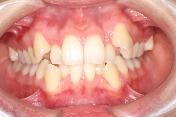 八重歯の矯正　ハーフリンガルによる目立たない抜歯矯正 ビフォー