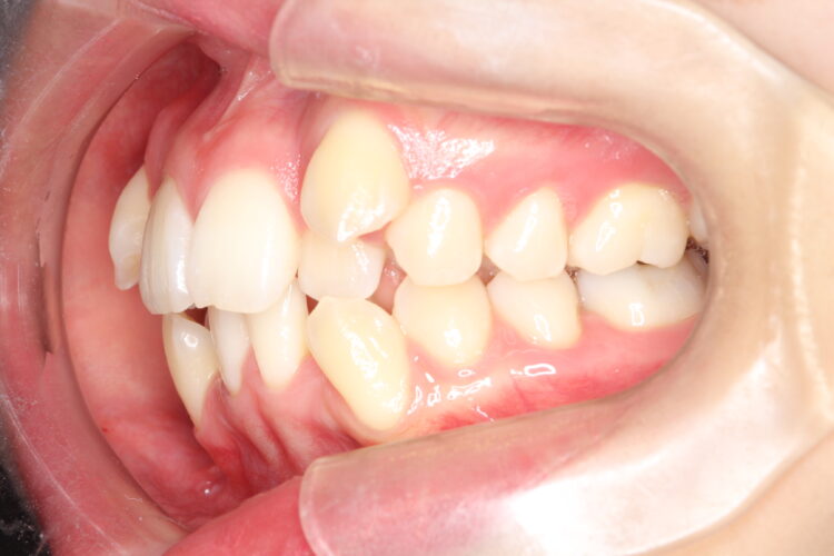 八重歯の矯正　ハーフリンガルによる目立たない抜歯矯正 治療前画像