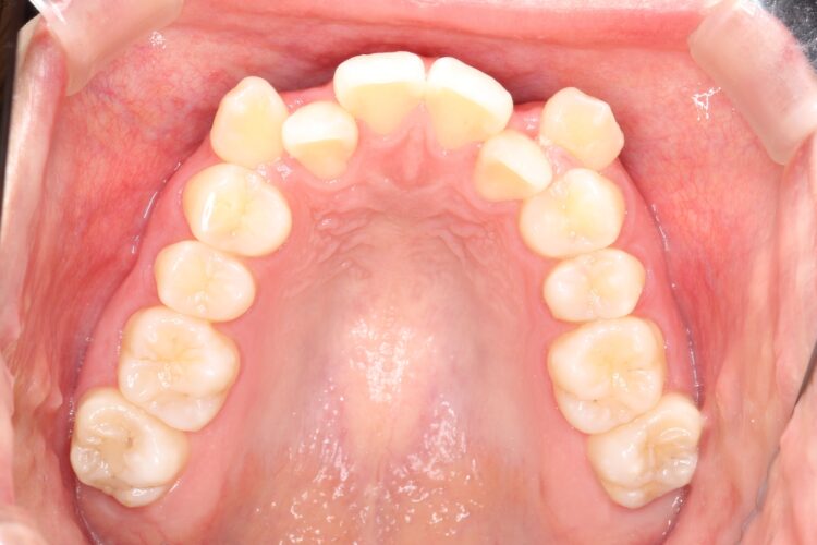 八重歯の矯正　ハーフリンガルによる目立たない抜歯矯正 治療前画像