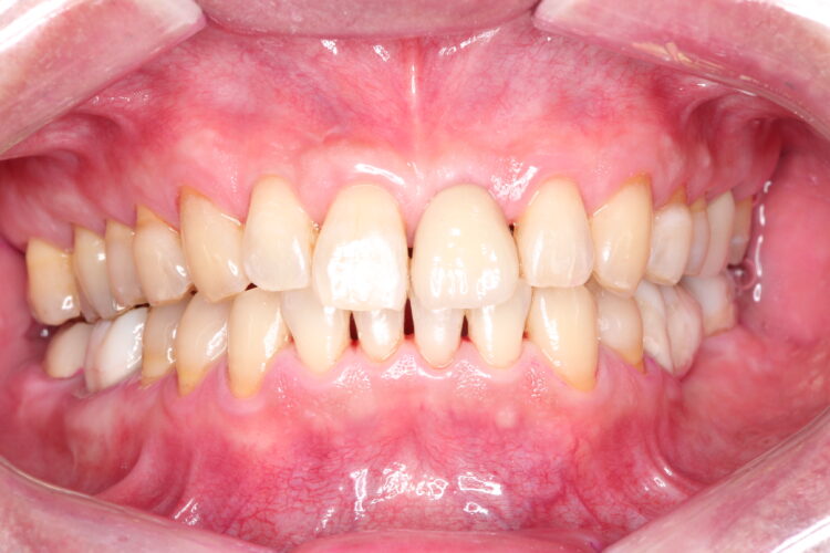 プロフェッショナルクリーニング（PMTC)で歯のステインを除去 治療後画像