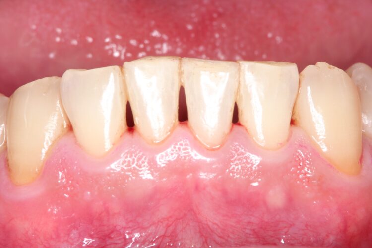 プロフェッショナルクリーニング（PMTC)で歯のステインを除去 治療後画像