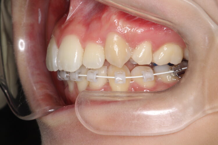 八重歯の矯正　ハーフリンガルによる目立たない抜歯矯正 治療途中画像