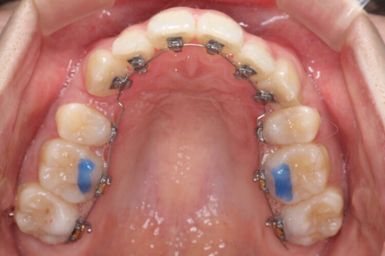八重歯の矯正　ハーフリンガルによる目立たない抜歯矯正 治療途中画像