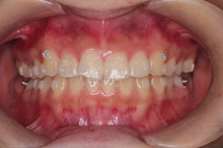 出っ歯の非抜歯矯正　インビザラインで目立たず・ばれずに矯正 治療途中画像