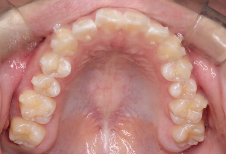 出っ歯の非抜歯矯正　インビザラインで目立たず・ばれずに矯正 治療途中画像