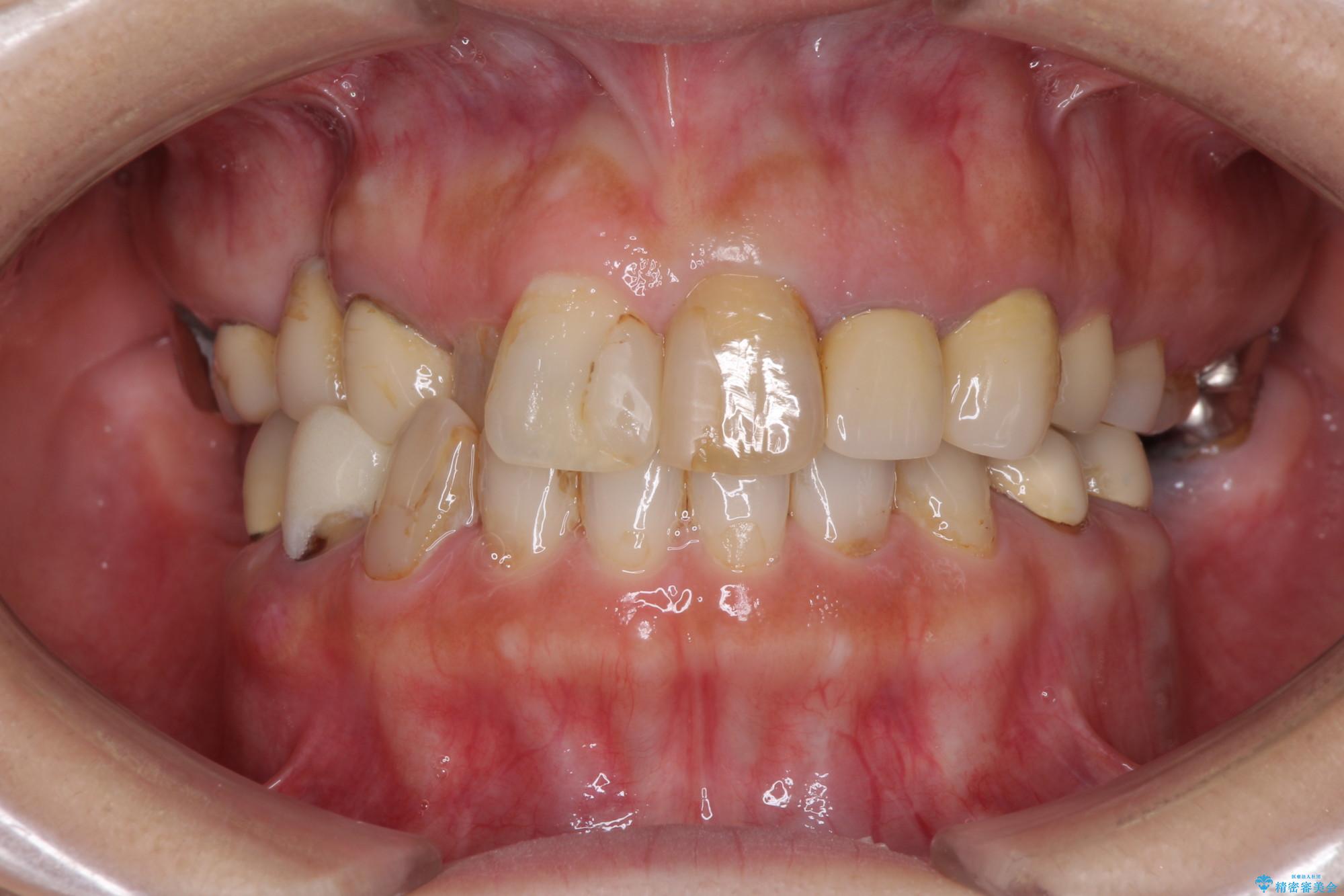 歯列矯正とセラミックで美しい口元に 治療前