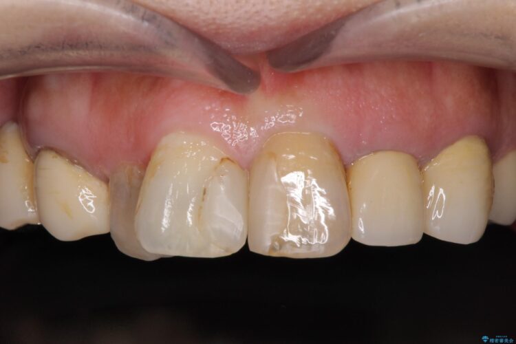 歯列矯正とセラミックで美しい口元に 治療前画像