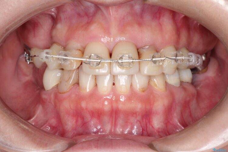 歯列矯正とセラミックで美しい口元に 治療途中画像