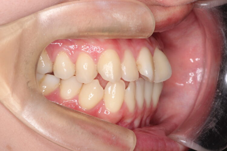 ガタガタをインビザラインで非抜歯矯正 治療前画像