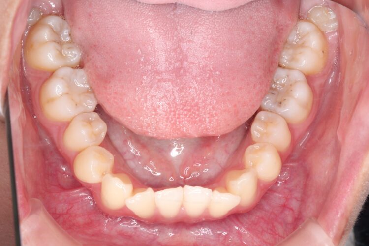 ガタガタをインビザラインで非抜歯矯正 治療前画像