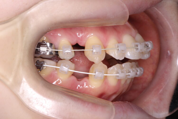 前歯で咬めない　ワイヤーでの抜歯矯正 治療途中画像