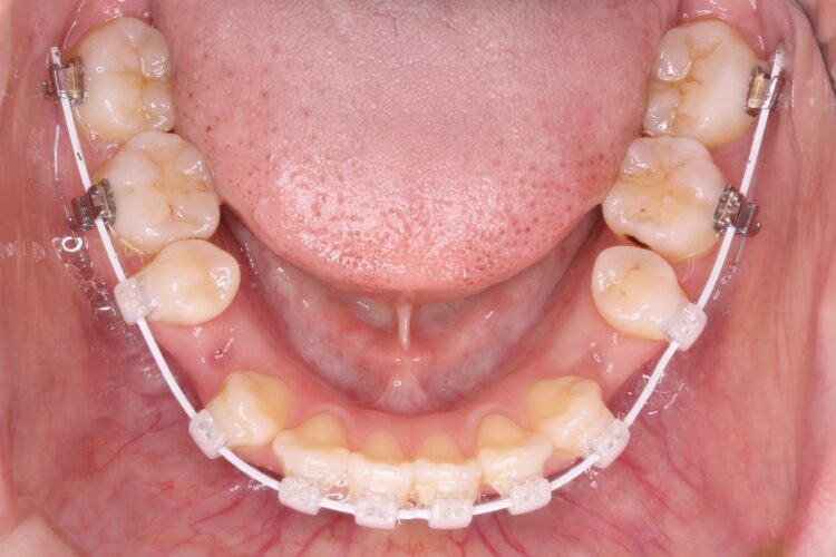 前歯で咬めない　ワイヤーでの抜歯矯正 治療途中画像