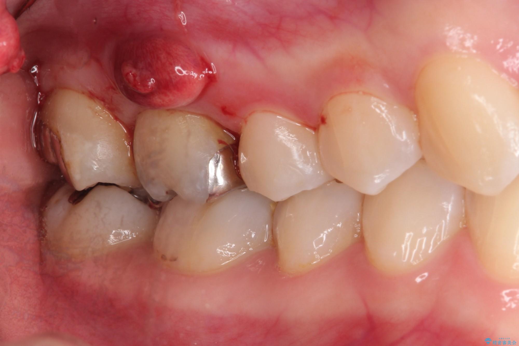 歯茎がはれた　根の治療をしっかり行ってからのセラミック治療 治療前