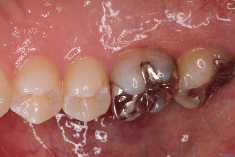 歯茎がはれた　根の治療をしっかり行ってからのセラミック治療 治療前画像