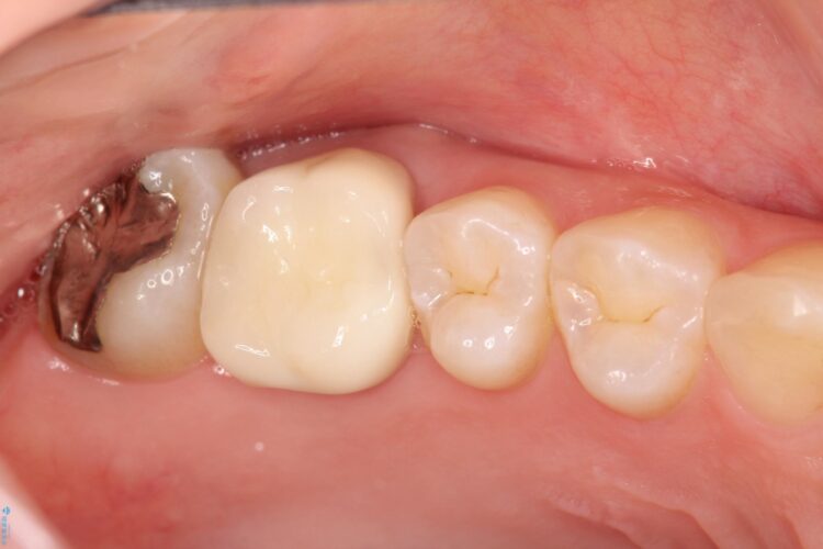 歯茎がはれた　根の治療をしっかり行ってからのセラミック治療 治療後画像