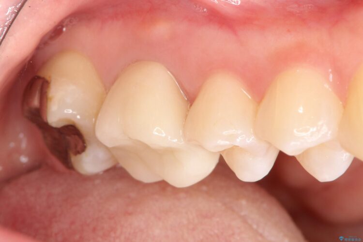 歯茎がはれた　根の治療をしっかり行ってからのセラミック治療 治療後画像