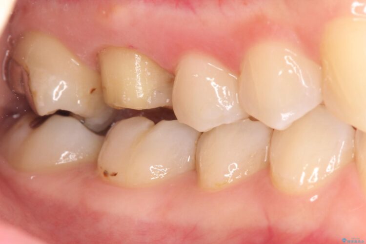 歯茎がはれた　根の治療をしっかり行ってからのセラミック治療 治療途中画像