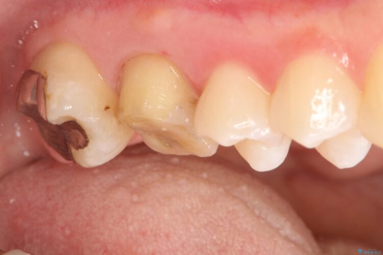歯茎がはれた　根の治療をしっかり行ってからのセラミック治療 治療途中画像