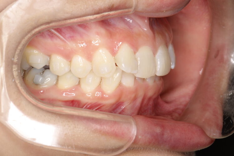 飛び出た前歯のインビザラインによる目立たない矯正 治療途中画像