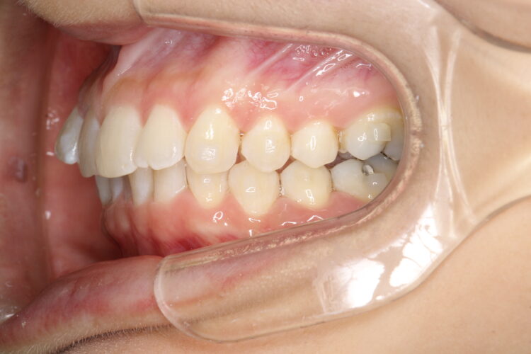 飛び出た前歯のインビザラインによる目立たない矯正 治療途中画像