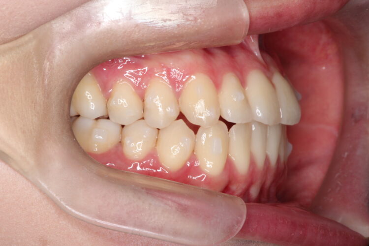 ガタガタをインビザラインで非抜歯矯正 治療途中画像