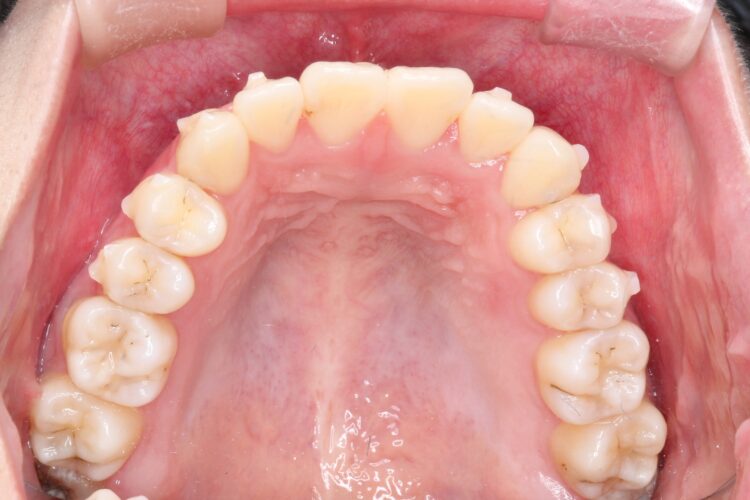ガタガタをインビザラインで非抜歯矯正 治療途中画像