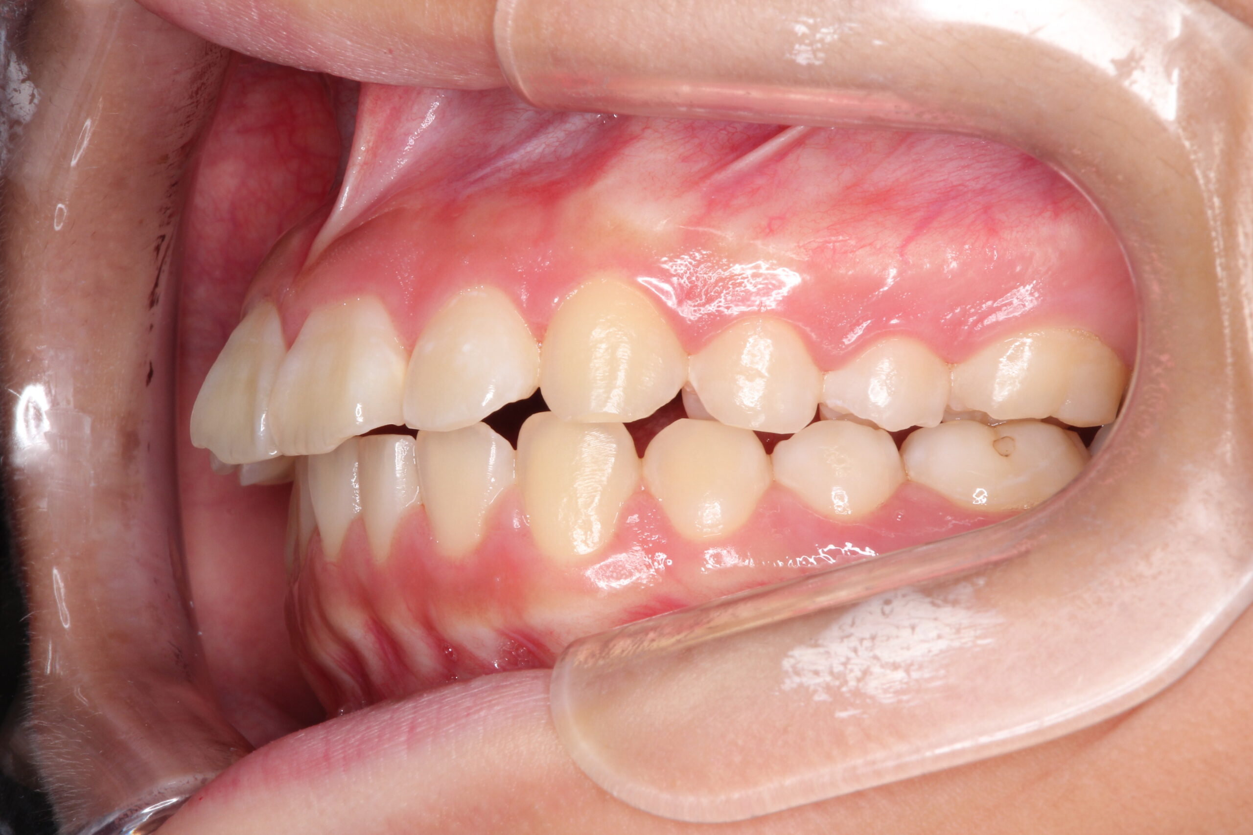 出っ歯の非抜歯矯正　インビザラインで目立たず・ばれずに矯正 治療前