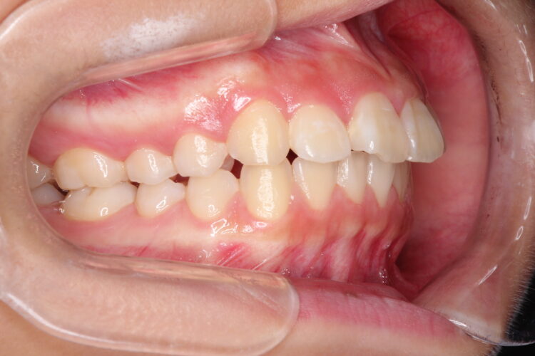出っ歯の非抜歯矯正　インビザラインで目立たず・ばれずに矯正 治療前画像