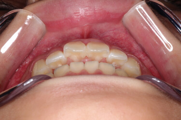 出っ歯の非抜歯矯正　インビザラインで目立たず・ばれずに矯正 治療前画像