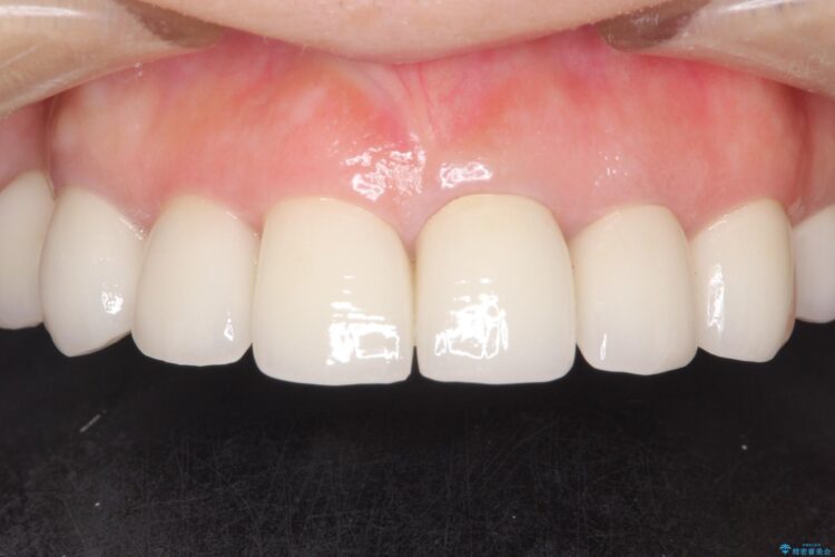 歯列矯正とセラミックで美しい口元に 治療後画像