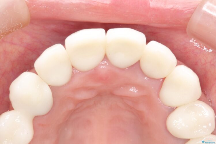 歯列矯正とセラミックで美しい口元に 治療後画像