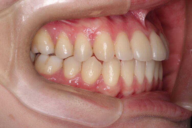 ガタガタをインビザラインで非抜歯矯正 治療後画像