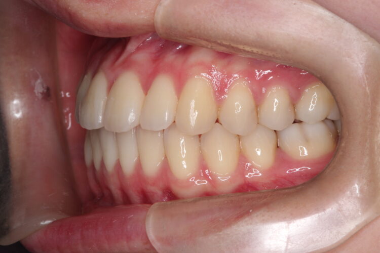 ガタガタをインビザラインで非抜歯矯正 治療後画像