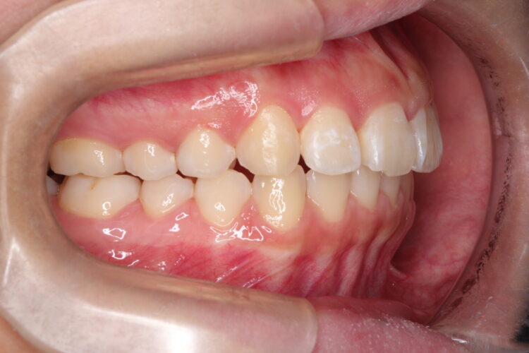 出っ歯の非抜歯矯正　インビザラインで目立たず・ばれずに矯正 治療後画像