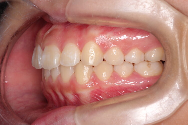 出っ歯の非抜歯矯正　インビザラインで目立たず・ばれずに矯正 治療後画像