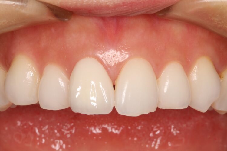 前歯の色を自然にしたい 治療後画像