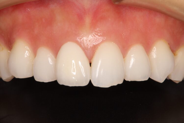 前歯の色を自然にしたい 治療後画像