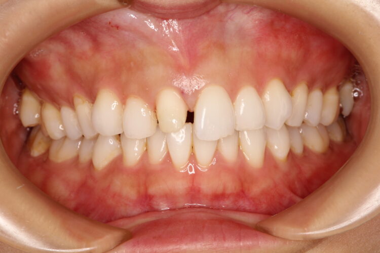 前歯の色を自然にしたい 治療途中画像
