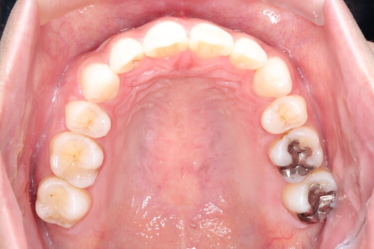 口ゴボをワイヤーによる抜歯矯正ですっきりとした口元へ 治療後画像